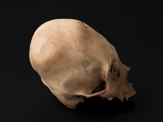 Cráneo con deformación anular erecta