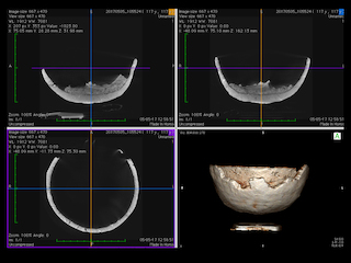 Vistas de la reconstrucción multiplanar y reconstrucción de volumen.