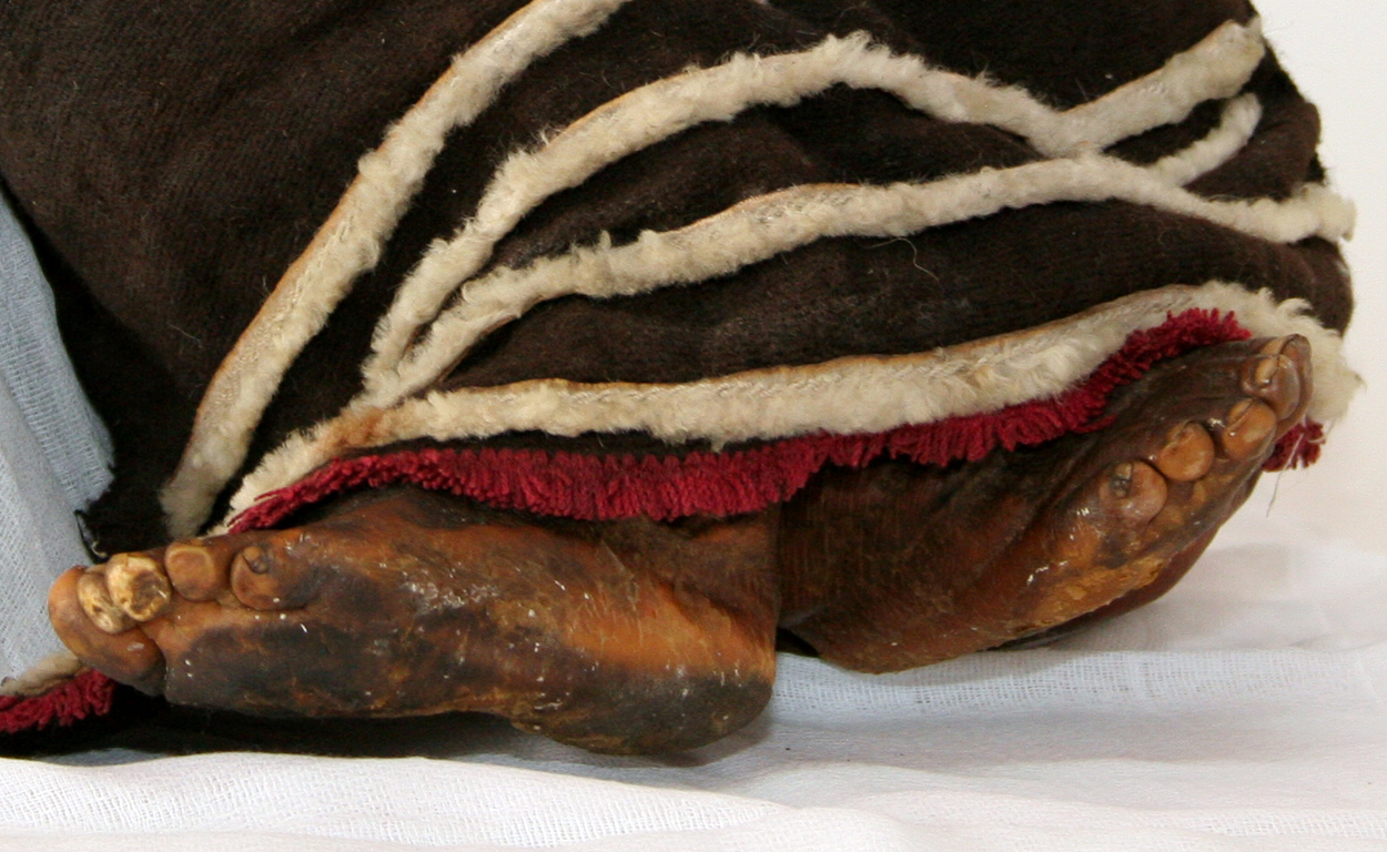 Se destaca el edema producido por la caminata y la marca dejada por los mocasines.