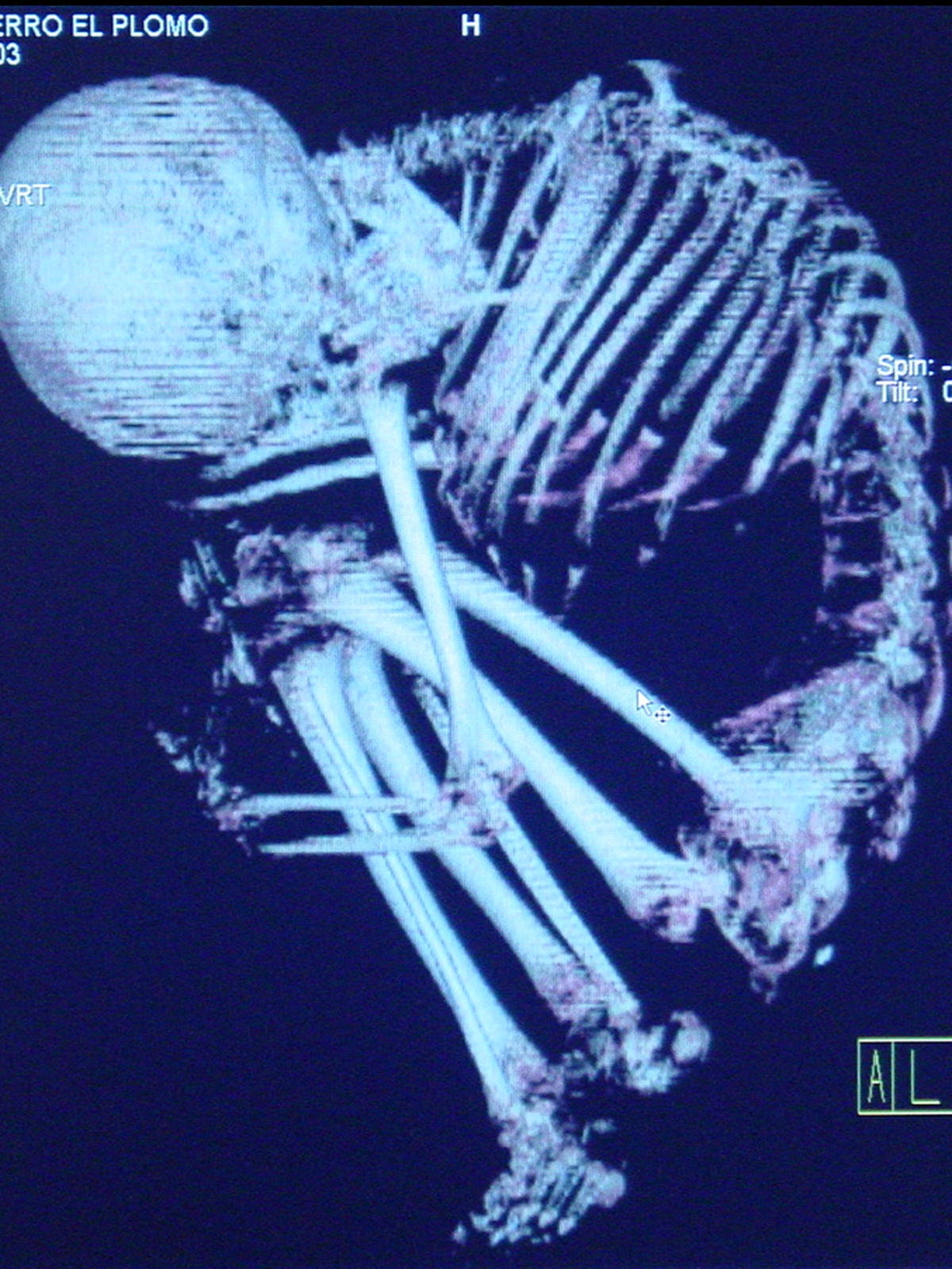 Esqueleto del niño donde se observa la ausencia de fracturas u otras lesiones