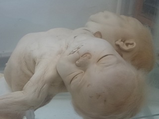 Siamesa Bicéfala, colección de teratología MHNV.