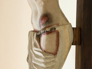 Cadera y reparación de la grieta